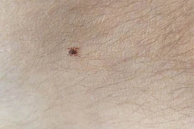 Kleszcz czy pieprzyk? Sprawdź, zanim spanikujesz! Ekspert radzi