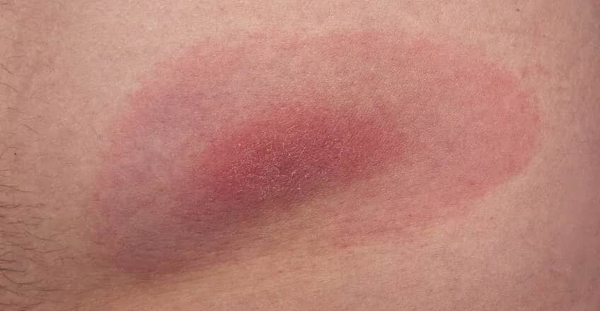 Rumień po kleszczu: Jak długo się utrzymuje? Odczyn czy borelioza?